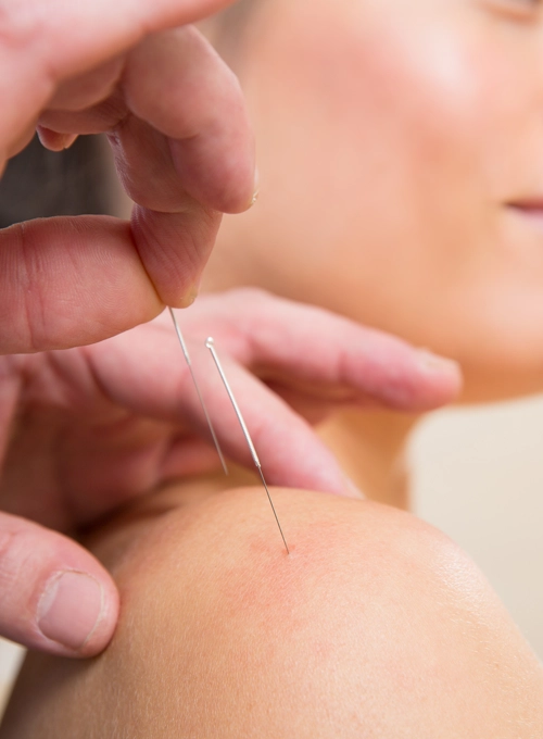 Chiropractic West Allis WI Dry Needling